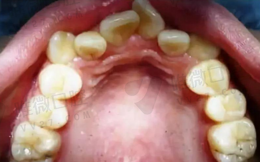 种值牙与活动假牙的区别,种植牙8年后(图1)